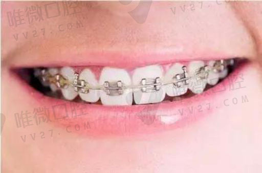胶托活动假牙和钢托的区别,牙齿胶托价格(图1)